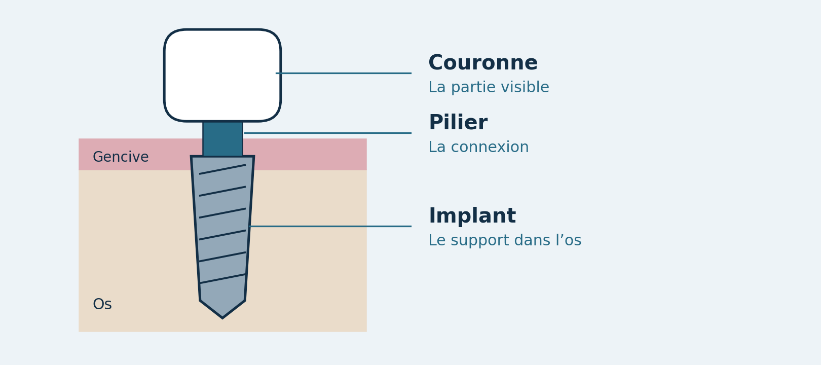 Schéma d’une dent sur implant : couronne visible, pilier de connexion et implant ancré dans l’os, sous la gencive.